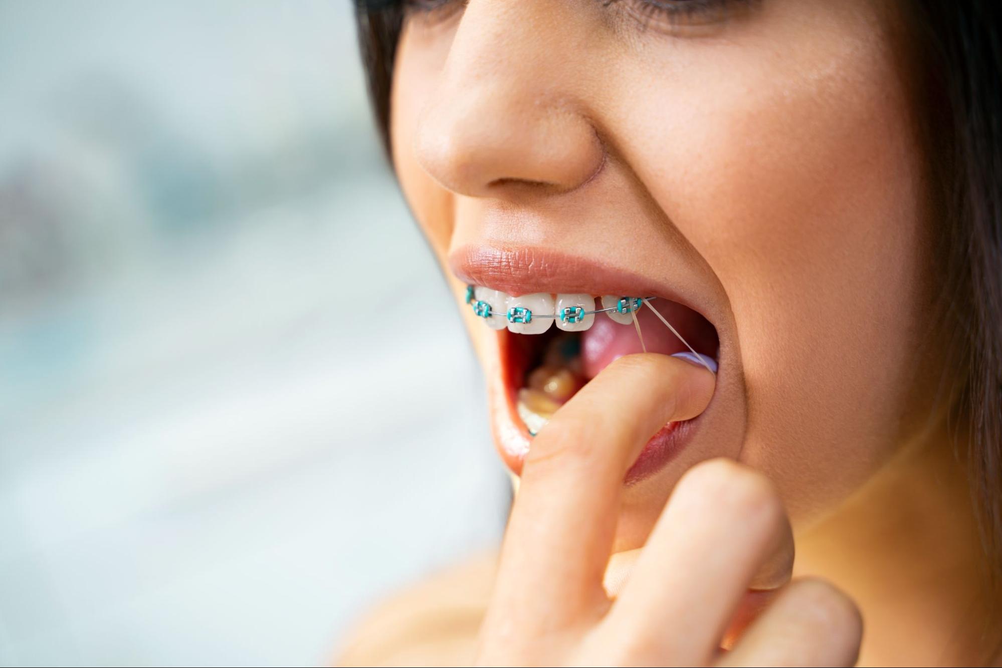 Everything You Need to Know About Wearing Elastics With Braces