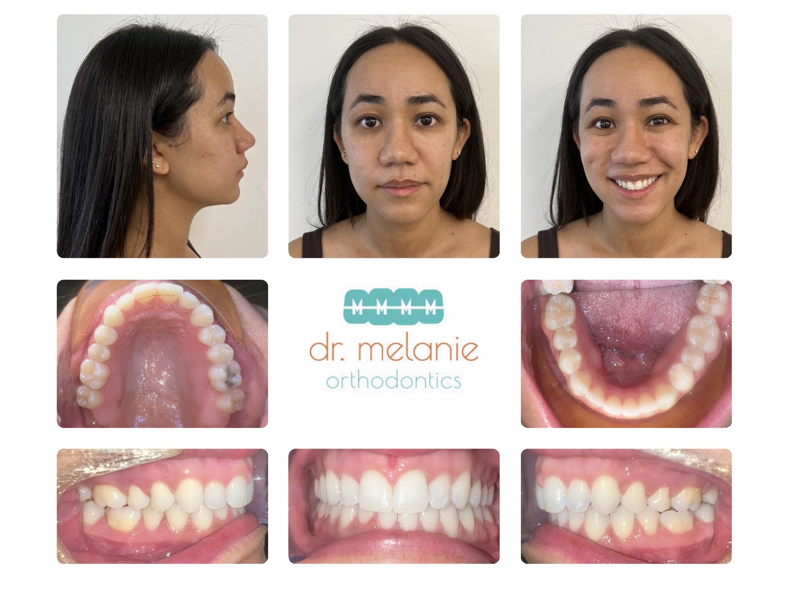 Aligners Limited Ryan after