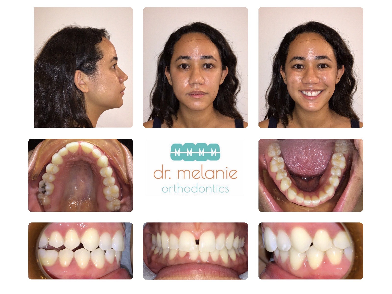 Aligners limited Ryan before